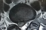 MRI scan of spine showing a spinal disc compressing a nerve root and abutting the spinal cord