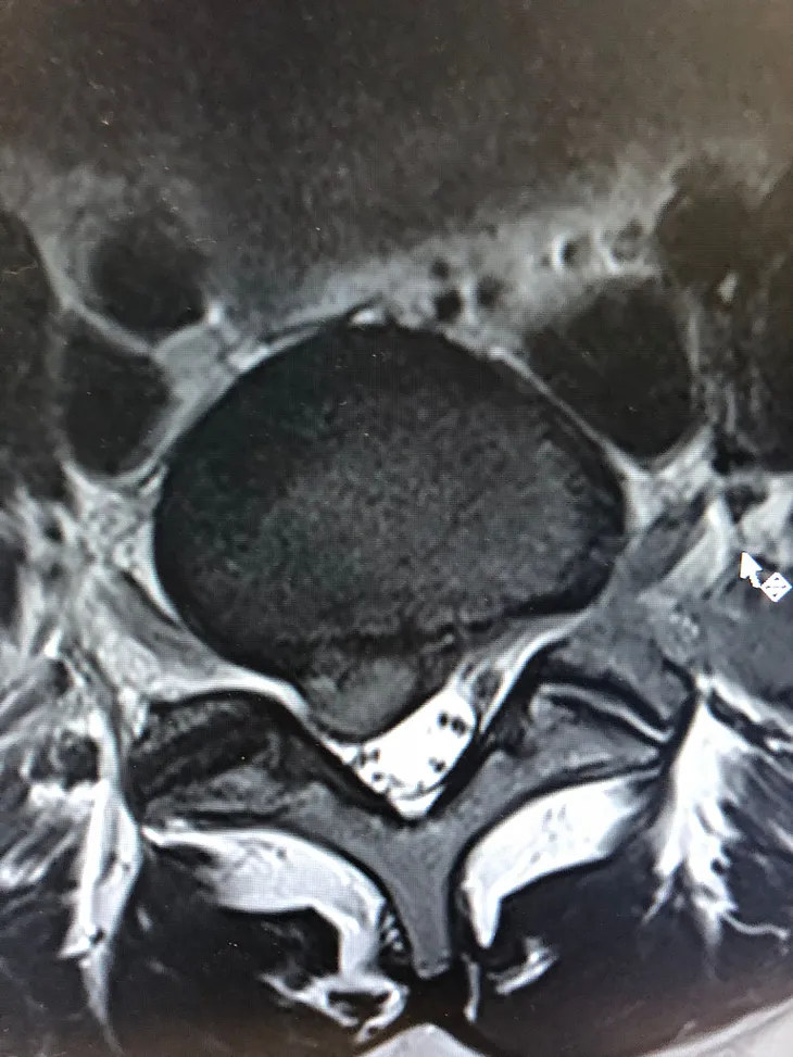 MRI scan of spine showing a spinal disc compressing a nerve root and abutting the spinal cord